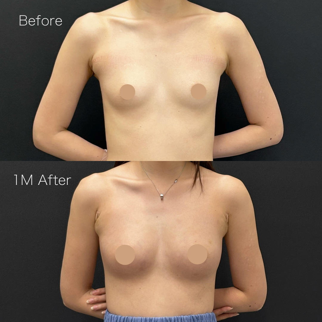 脂肪注入豊胸の症例の症例画像