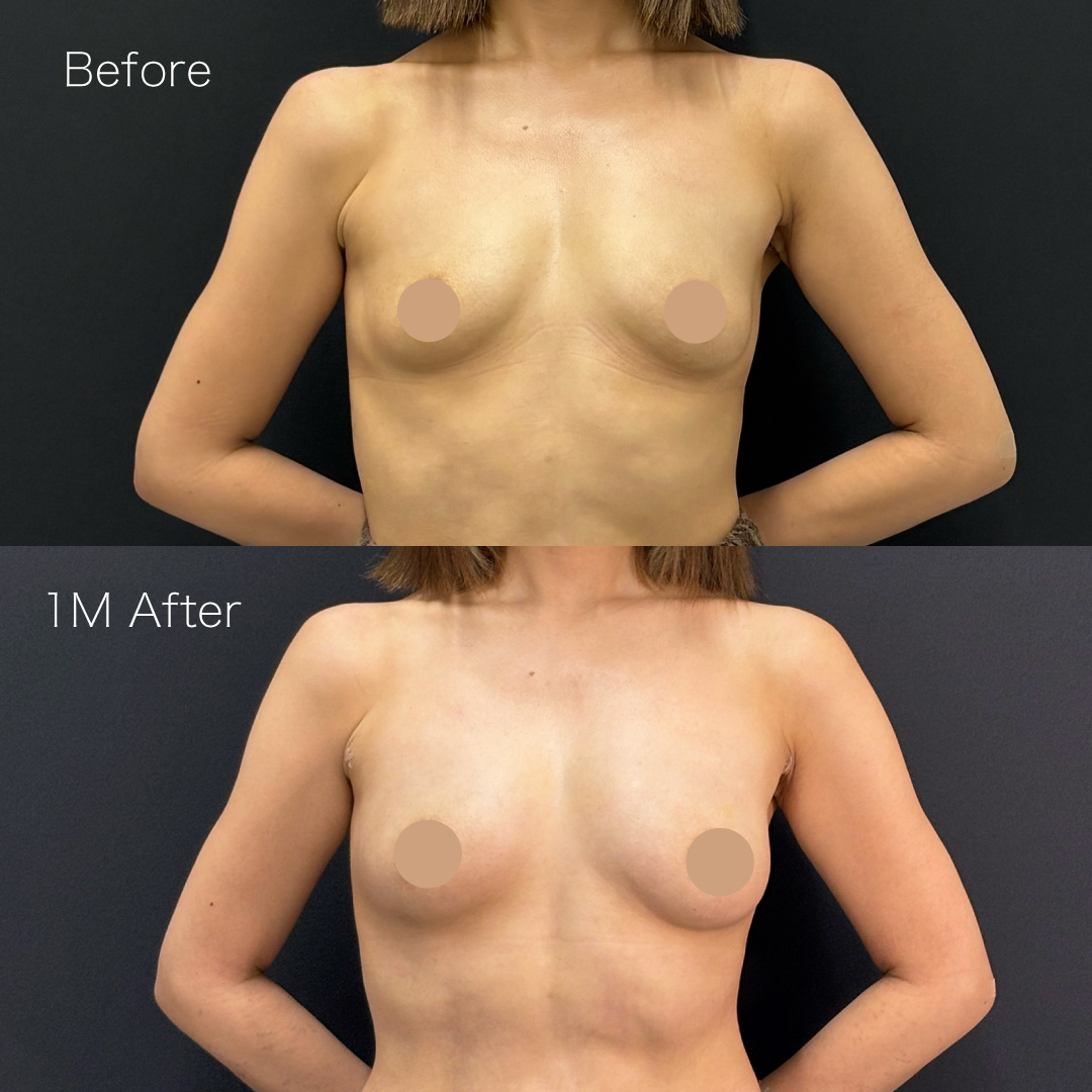脂肪注入豊胸の症例の症例画像