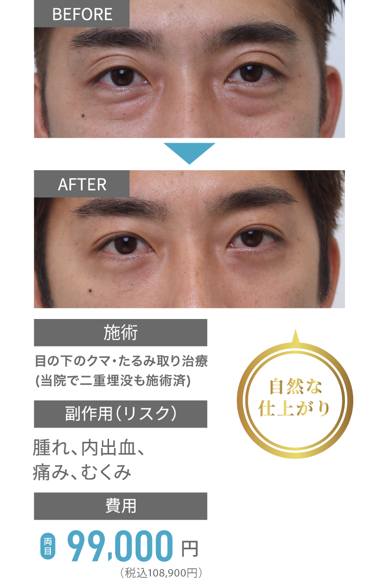 自然な仕上がり before/after 施術：目の下のクマ・たるみ取り治療（当院で二重埋没も施術済）、副作用（リスク）：腫れ・内出血・痛み・むくみ、費用：両目99,000円（税込108,900円）