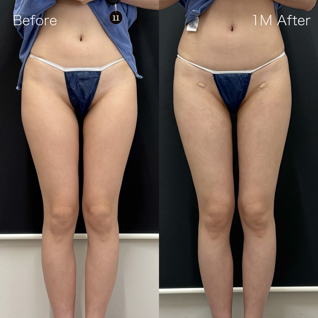 身体脂肪吸引の症例の症例画像