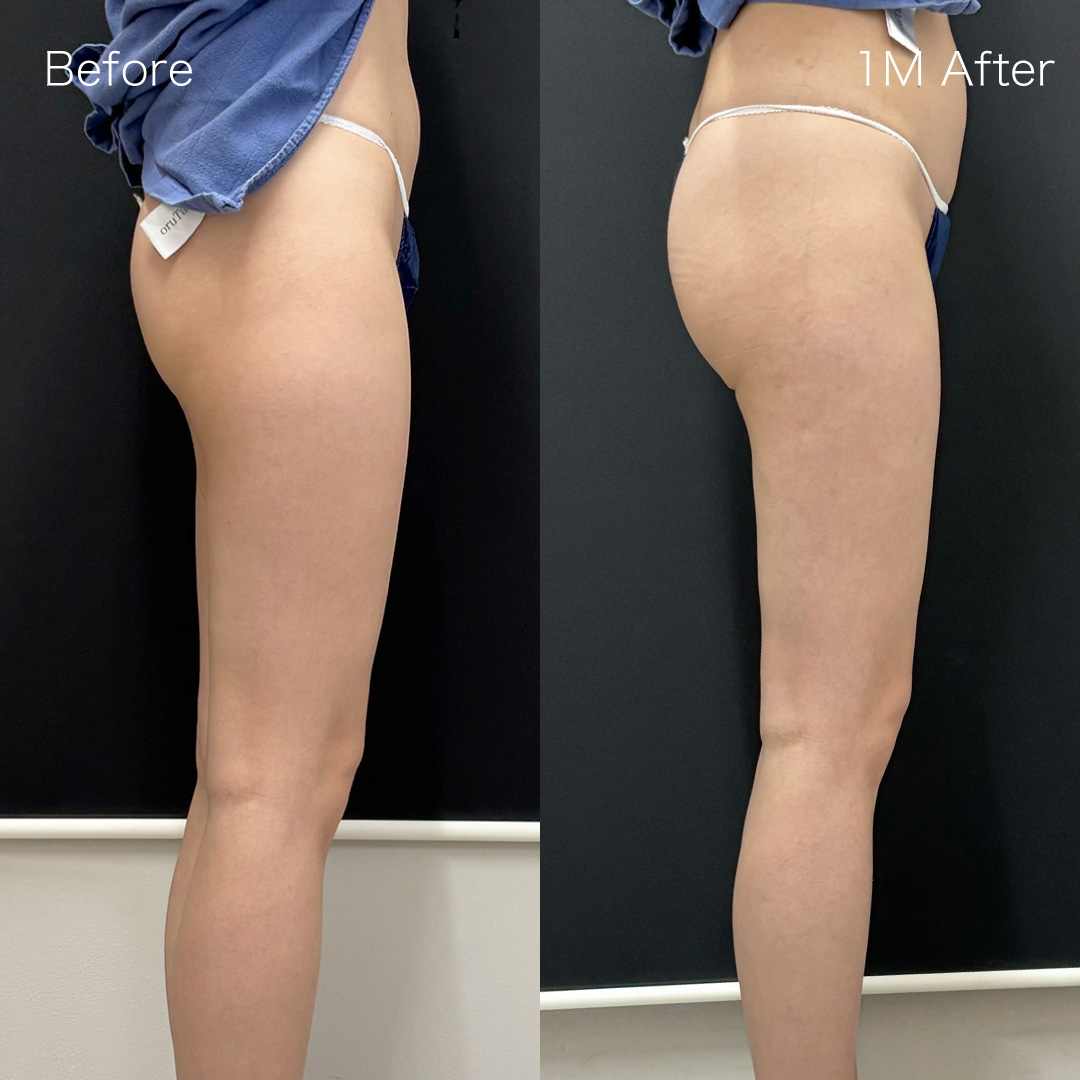 身体脂肪吸引の症例の症例画像