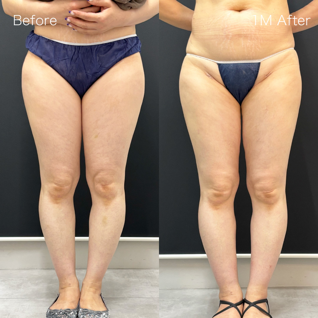 身体脂肪吸引の症例の症例画像