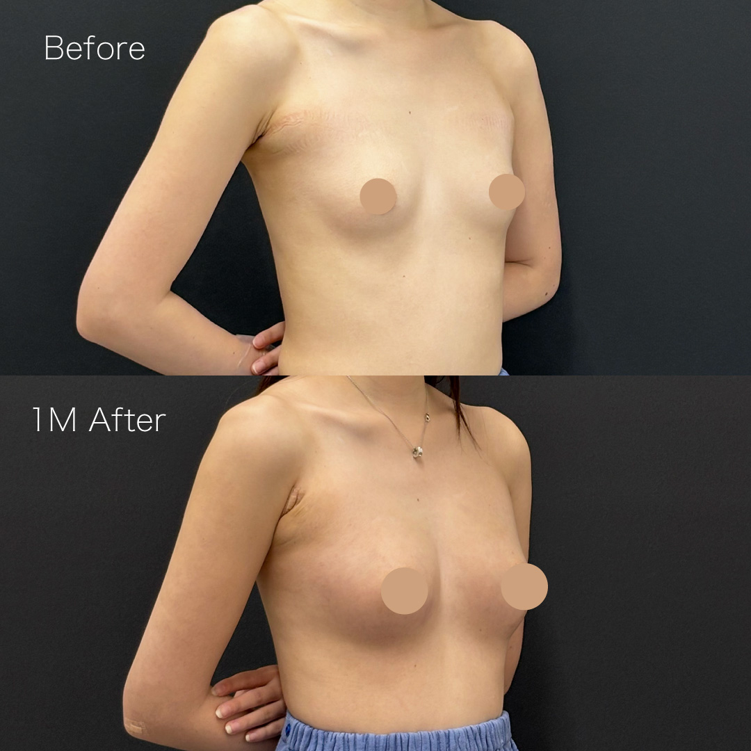 脂肪注入豊胸の症例の症例画像