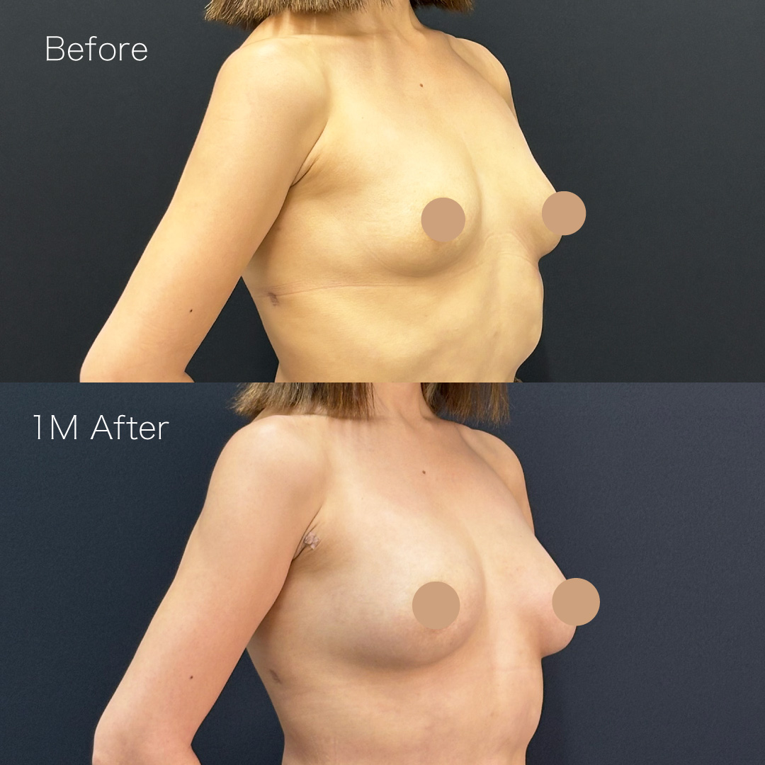 脂肪注入豊胸の症例の症例画像