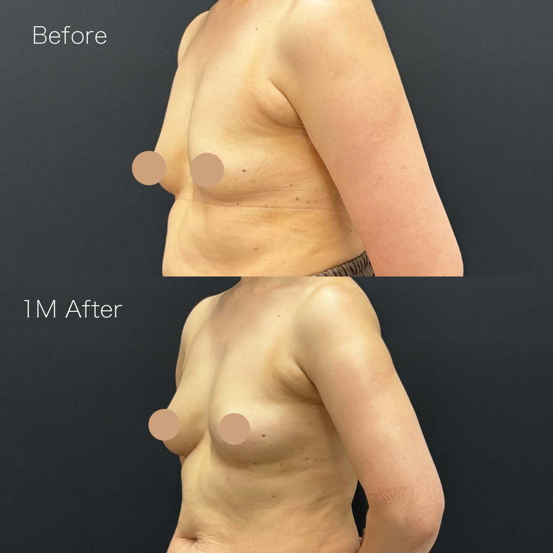 脂肪注入豊胸の症例の症例画像