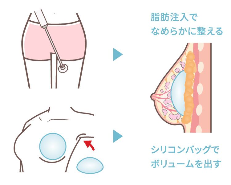 ハイブリッド豊胸のイメージイラスト シリコンバッグでボリュームを出し脂肪注入でなめらかに整える