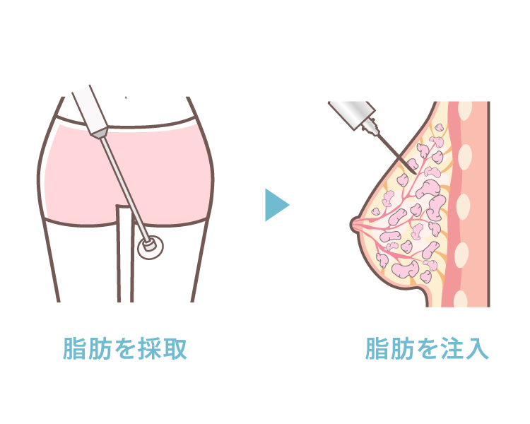 脂肪注入豊胸のイメージイラスト 脂肪を採取してバストに注入