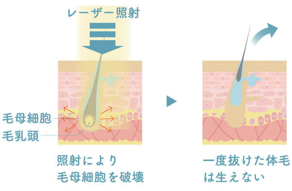 ミセルクリニックの医療レーザーの仕組み断面図。照射により毛母細胞を破壊。一度抜けた体毛は生えない。