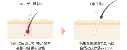 脱毛イメージ