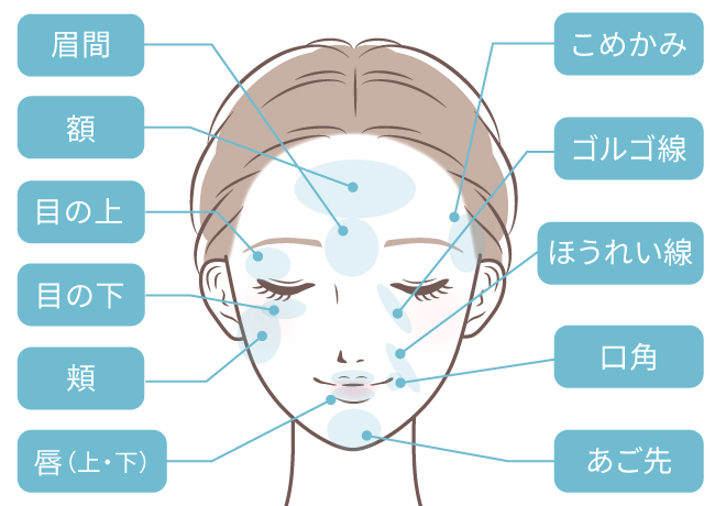 プレミアム脂肪注入（顔の脂肪注入）の対象部位 イラスト