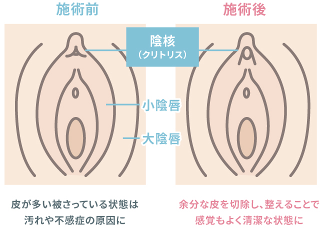 陰核(クリトリス)包茎術とは イラスト