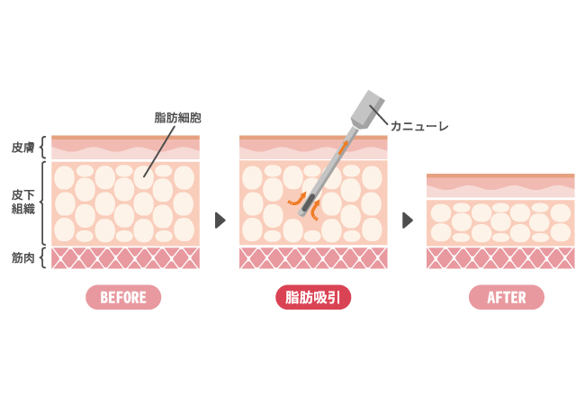 小顔脂肪吸引 イメージ図