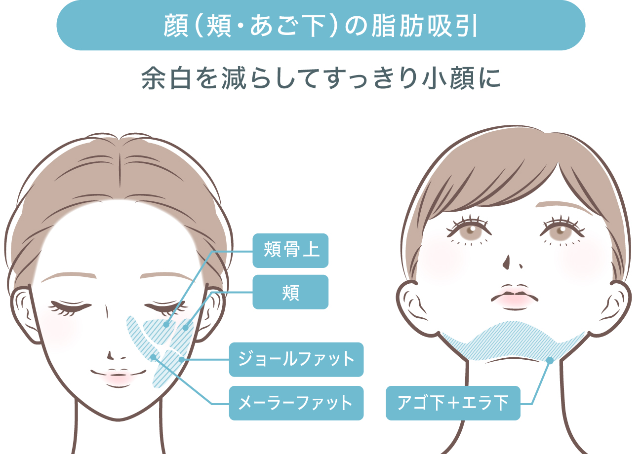 小顔脂肪吸引 イメージ図
