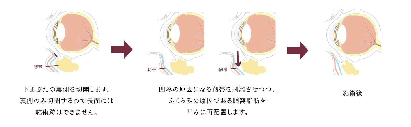 裏ハムラ