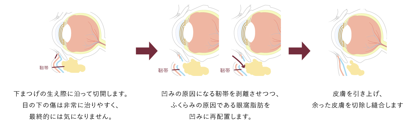 切開ハムラ法