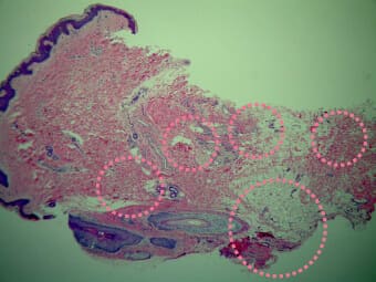 ミラドライ施術前後撮影した汗腺が破壊された様子