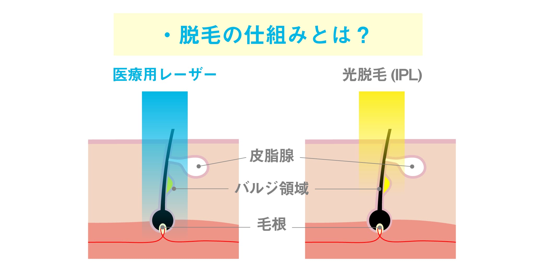 ミセルクリニック姫路院　脱毛の仕組みとは？